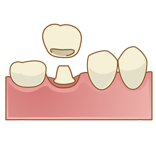 クラウン（被せ物の場合）